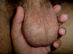AssnBalls blog: Massive scrotum